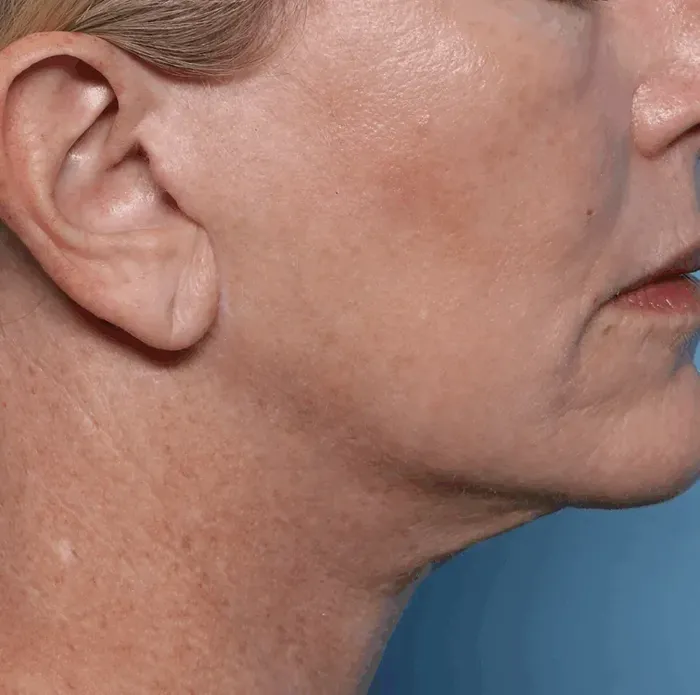 Jawline, after treatment